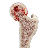 Core Decompression for Avascular Necrosis of the Hip