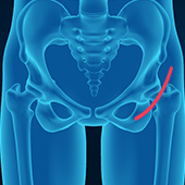 Outpatient Hip Replacement Surgery